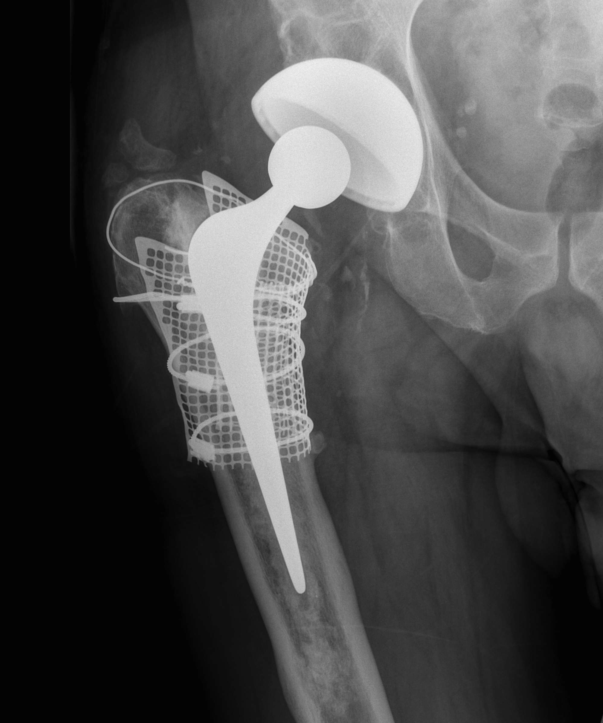 Revision Femur Type 3 Mesh and Impaction Bone Grafting